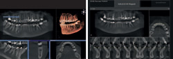 歯科用CT3D撮影