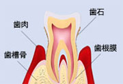 歯周病