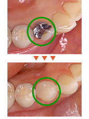 白い詰め物・かぶせ物